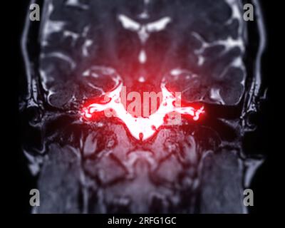 Scansione cerebrale RM con vista coronale del canale uditivo interno (IAC). Foto Stock