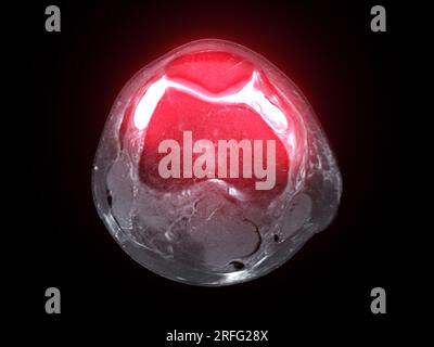 Risonanza magnetica o RM dell'articolazione del ginocchio vista assiale T2 FS per rilevare lacerazioni o distorsione del legamento crociato anteriore (LCA) Foto Stock