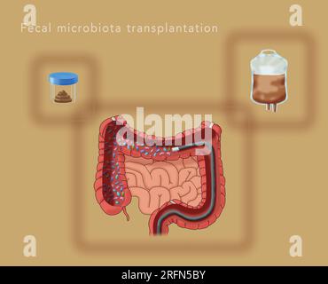 Un'illustrazione dei componenti del trapianto di microbiota fecale per migliorare il bioma umano. Le raccolte da un donatore sano, la preparazione con soluzione salina in una sacca di gocciolamento IV, e una colonscopia. Foto Stock