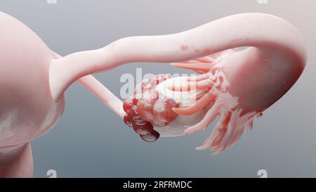 Tumore maligno dell'ovaio, anatomia dell'utero femminile, sistema riproduttivo, cellule tumorali, cisti ovariche, cancro cervicale, cellule in crescita, malattie ginecologiche Foto Stock