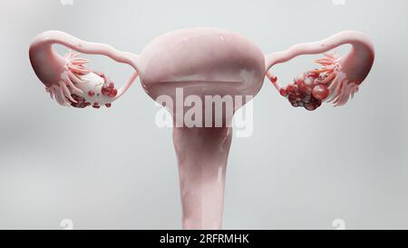 Tumore maligno dell'ovaio, anatomia dell'utero femminile, sistema riproduttivo, cellule tumorali, cisti ovariche, cancro cervicale, cellule in crescita, malattie ginecologiche Foto Stock