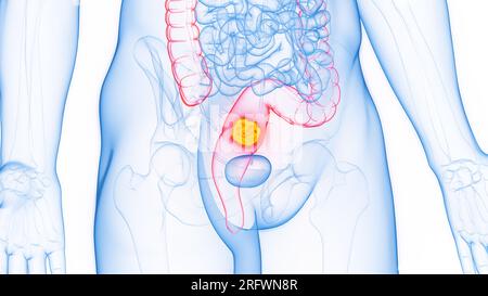 Cancro del retto, illustrazione Foto Stock