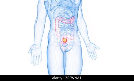 Cancro del retto, illustrazione Foto Stock