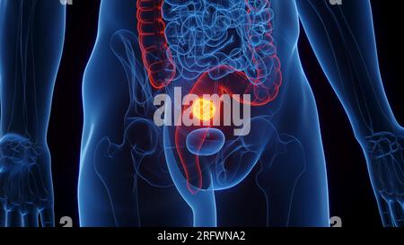 Cancro del retto, illustrazione Foto Stock