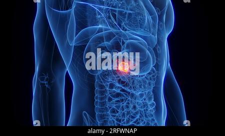 Cancro pancreatico, illustrazione Foto Stock