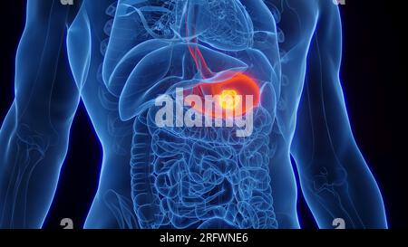 Il cancro dello stomaco, illustrazione Foto Stock