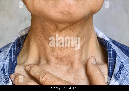 Invecchiamento della pelle pieghe o pieghe della pelle o rughe al collo del sud-est asiatico, uomo vecchio cinese. Concetto di mal di gola. Foto Stock
