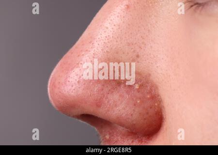 Giovane con problema di acne su sfondo grigio, vista ravvicinata del naso Foto Stock