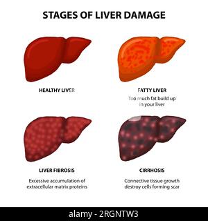 Fasi del danno epatico illustrazione fegato sano, fegato grasso, e fibrosi epatica. Foto Stock