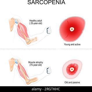 sarcopenia. Confronto e differenza tra i muscoli di adulto sano e braccio con atrofia. Sezione trasversale di Muscle of Young Active Person e Old Illustrazione Vettoriale