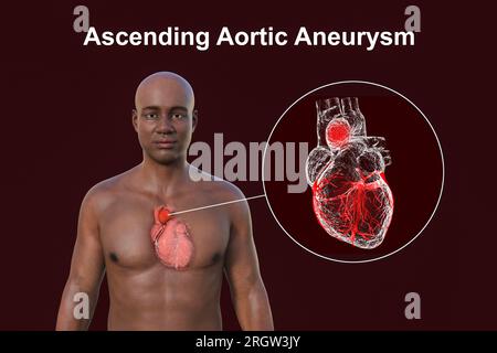 Aneurisma aortico ascendente, illustrazione Foto Stock
