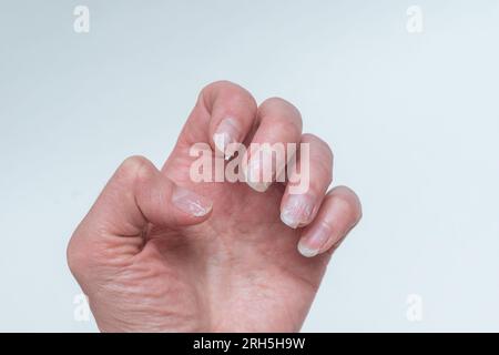 Unghia morso e rotto senza manicure con una cuticola troppo grande del chiodo e una piastra danneggiata del chiodo dopo l'applicazione del gel smalto. Palmo di una donna. COS Foto Stock