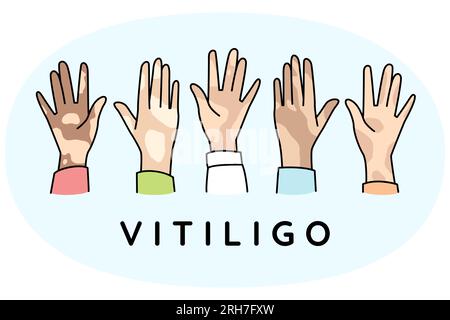 Mani diverse di persone soffrono di malattia vitiligine. La gente lotta con pigmentazione sul corpo. Concetto di giorno di vitiligo di mondo. Illustrazione vettoriale. Illustrazione Vettoriale