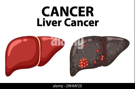 Infografica che illustra l'anatomia delle cellule tumorali epatiche Illustrazione Vettoriale
