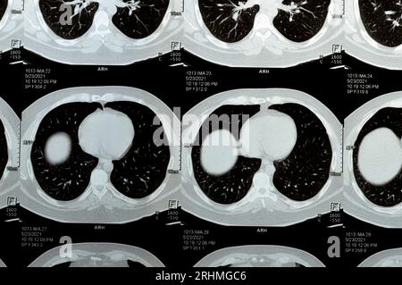 Scansione TC multistrato del torace che mostra uno studio normale, un aspetto normale dei polmoni, parenchima, vascolarizzazione polmonare, strutture mediastiniche, no Foto Stock