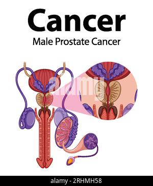 Infografica che illustra il cancro alla prostata maschile e la crescita anormale delle cellule Illustrazione Vettoriale
