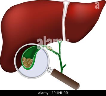 Fegato umano. Primo piano della cistifellea. la lente d'ingrandimento esamina i calcoli biliari nella cistifellea. Problemi di discinesia biliare, colecistite in laboratorio Illustrazione Vettoriale