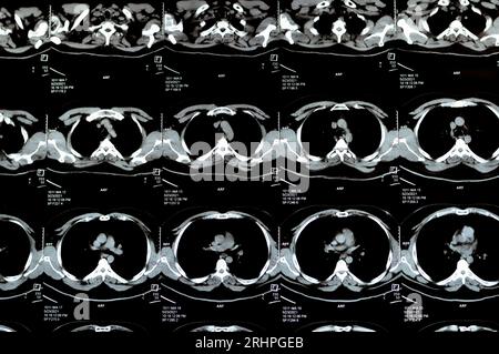 Scansione TC multistrato del torace che mostra uno studio normale, un aspetto normale dei polmoni, parenchima, vascolarizzazione polmonare, strutture mediastiniche, no Foto Stock