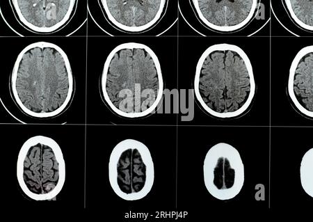 Scansione TC multistrato del cervello che mostra un grande tronco cerebrale e un ematoma semiovale centrale destro, normali strutture della fossa posteriore, dimensioni normali della ventilazione Foto Stock