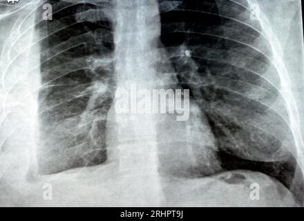 Radiografia semplice per un paziente con polmonite da aspirazione polmone destro, empiema, versamento pleurico dopo l'inserimento di un tubo toracico per drenare l'unità pu Foto Stock