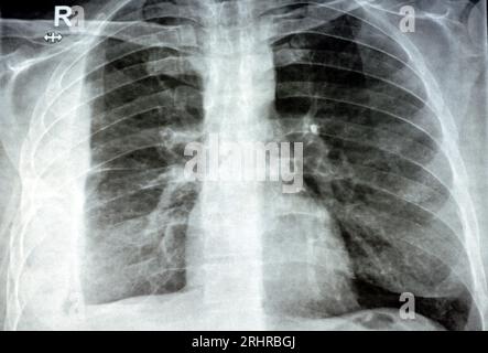 Radiografia semplice per un paziente con polmonite da aspirazione polmone destro, empiema, versamento pleurico dopo l'inserimento di un tubo toracico per drenare l'unità pu Foto Stock