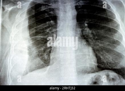 Radiografia semplice per un paziente con polmonite da aspirazione polmone destro, empiema, versamento pleurico dopo l'inserimento di un tubo toracico per drenare l'unità pu Foto Stock