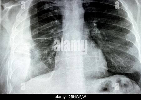 Radiografia semplice per un paziente con polmonite da aspirazione polmone destro, empiema, versamento pleurico dopo l'inserimento di un tubo toracico per drenare l'unità pu Foto Stock