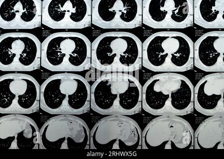 Scansione TC multistrato del torace che mostra uno studio normale, un aspetto normale dei polmoni, parenchima, vascolarizzazione polmonare, strutture mediastiniche, no Foto Stock