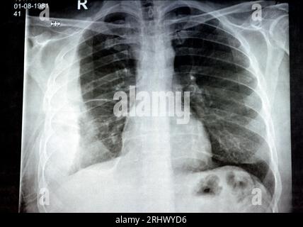 Radiografia semplice per un paziente con polmonite da aspirazione polmone destro, empiema, versamento pleurico dopo l'inserimento di un tubo toracico per drenare l'unità pu Foto Stock