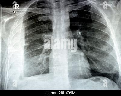 Radiografia semplice per un paziente con polmonite da aspirazione polmone destro, empiema, versamento pleurico dopo l'inserimento di un tubo toracico per drenare l'unità pu Foto Stock