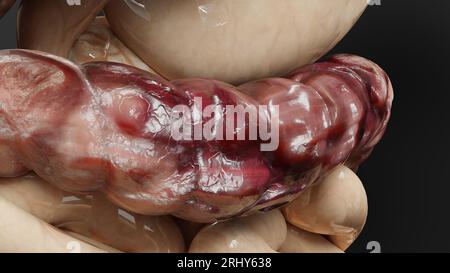 Cancro intestinale o tumore colorettale, cancro del colon, malattia infiammatoria intestinale, dolore intestinale, celiaco, infezioni, duplicazione, celle in espansione Foto Stock