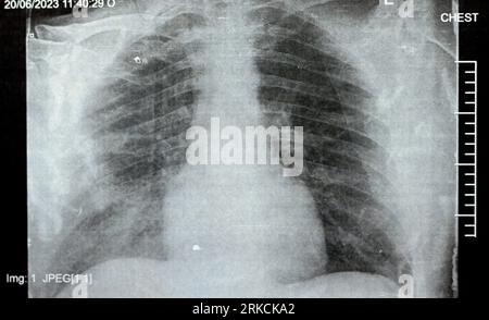 Radiografia toracica semplice che mostra polmonite infettiva da processo polmonare con lato destro versamento para-polmonare minimo, polmonite da aspirazione lato destro Foto Stock