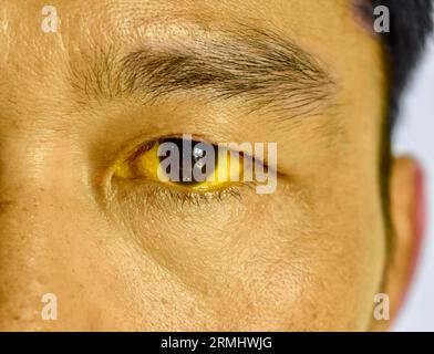 Ittero profondo in pazienti asiatici maschi. Colorazione giallastra della pelle e della sclera. Iperbilirubinemia. Epatite acuta. Foto Stock