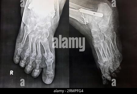 Radiografia liscia del piede destro di una vecchia paziente con una nuova frattura della fessura della base del 5° osso metatarso e precedente intervento chirurgico interno f Foto Stock