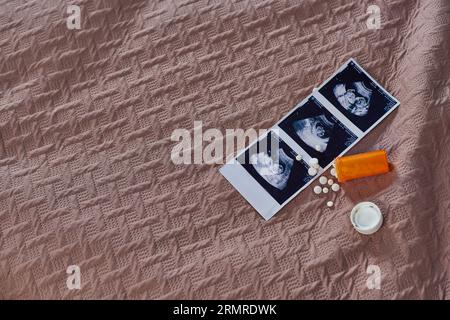 vista dall'alto del biberon con pillole, ultrasuoni, neonato, controllo delle nascite, camera da letto, concetto di aborto Foto Stock