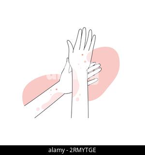 Mani umane coperte da eruzione cutanea rossa. Reazione allergica sulle mani, dermatite atopica illustrazione vettoriale della linea Illustrazione Vettoriale