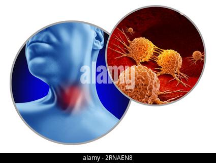 Cancro alla gola come crescita cellulare anormale come tumori aringei o faringei e HPV correlati come pazienti con tumore al collo Foto Stock