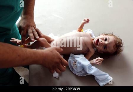 News Themen der Woche KW39 News Bilder des Tages Hungersnot im Jemen,Kinder in einem Krankenhaus in Sanaa (180924) - SANAA, 24 settembre 2018 - Un medico prende i vestiti di un bambino sofferto di carestia per essere controllato all'ospedale al-Sabaeen di Sanaa, Yemen, il 24 settembre 2018. Venerdì il sottosegretario generale delle Nazioni Unite per gli affari umanitari Mark Lowcock ha avvertito del pericolo di una carestia diffusa nello Yemen in mezzo a una crisi economica e a combattimenti che minacciano l'ancora di salvezza dei rifornimenti per i civili. ) (yg) YEMEN-SANAA-CARESTIA MohammedxMohammed PUBLICATIONxNOTxINxCHN Foto Stock