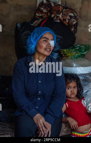 (190402) - PHNOM PENH, 2 aprile 2019 (Xinhua) - Sum Meyle si riposa con la figlia dopo aver ricevuto un'operazione di cataratta presso l'ospedale provinciale di Kampong Cham, Cambogia, 15 marzo 2019. Sum Meyle, 36 anni, è una madre single con cinque figli. Per contribuire a migliorare le loro condizioni finanziarie, due delle figlie di Meyle stanno ora lavorando nella capitale Phnom Penh, mentre due dei suoi figli vivono in una casa di cura per bambini. Meyle ora vive in una baraccopoli affittata con la figlia più giovane. Meyle aveva sofferto di cataratta dopo che il suo occhio sinistro era stato ferito. Sette mesi fa, aveva degli almos Foto Stock