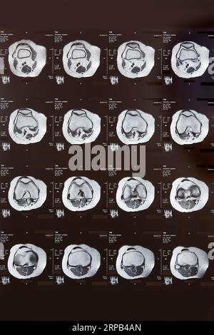 Imaging a risonanza magnetica del ginocchio. Diagnosi RM. Assistenza sanitaria Foto Stock