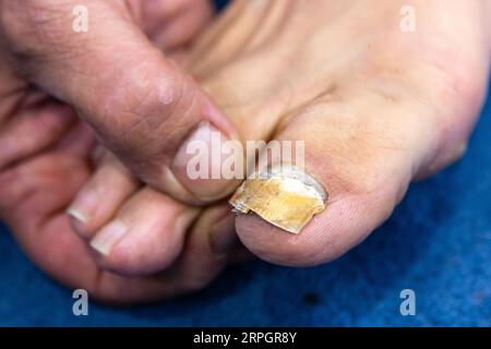 Macro di un chiodo umano con infezione fungina. Alluce grande con onicomicosi avanzata. Primo piano del piede e della mano analizzando il chiodo con micosi cronica Foto Stock