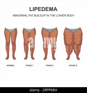 Illustrazione delle fasi lipedema Foto Stock