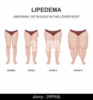 Illustrazione delle fasi lipedema Foto Stock