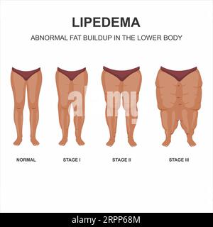 Illustrazione delle fasi lipedema Foto Stock