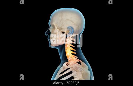 Vista laterale della sezione cervicale della lesione della colonna vertebrale e dolore su sfondo nero Foto Stock