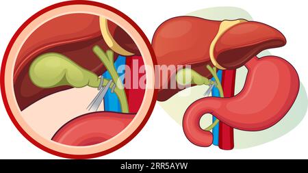 Rimozione della vescica biliare - colecistectomia - illustrazione delle scorte come file EPS 10 Illustrazione Vettoriale
