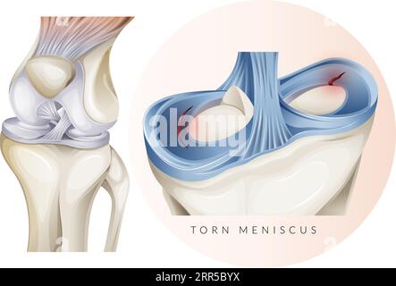 Lesione della cartilagine del ginocchio - menisco lacerato - illustrazione stock come file EPS 10 Illustrazione Vettoriale