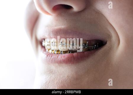 parentesi dentarie in metallo sui denti di una ragazzina primo piano Foto Stock
