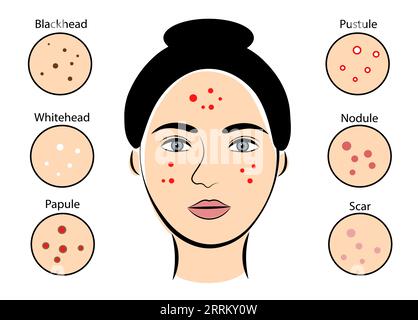 Ragazza con acne su sfondo bianco Illustrazione Vettoriale