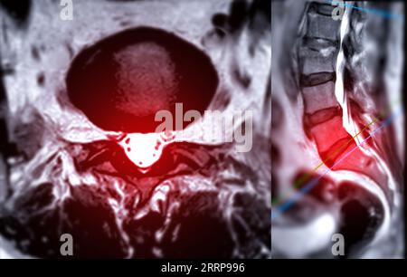 Tecnica RM colonna vertebrale L-S o T2 sagittale della colonna lombare per la diagnosi della compressione del midollo spinale. Foto Stock